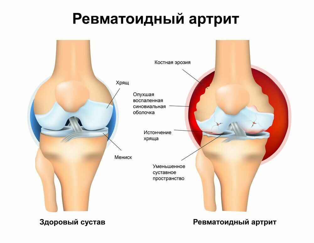 Ревматоидный остеоартроз. Ревматоидный артрит коленного сустава. Артрит коленного сустава мкб 10. Артрит коленного сустава мкб. Реактивный ревматоидный артрит.