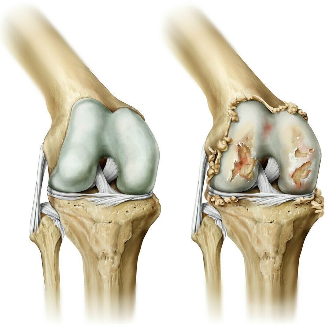 Гонартроз коленного сустава - лечение и симптомы, диагностика | Клиника доктора Длина